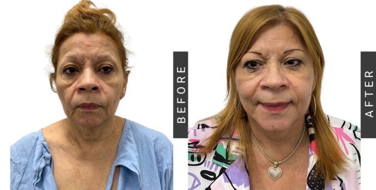 Guía Definitiva: Preparación para Cirugía Plástica