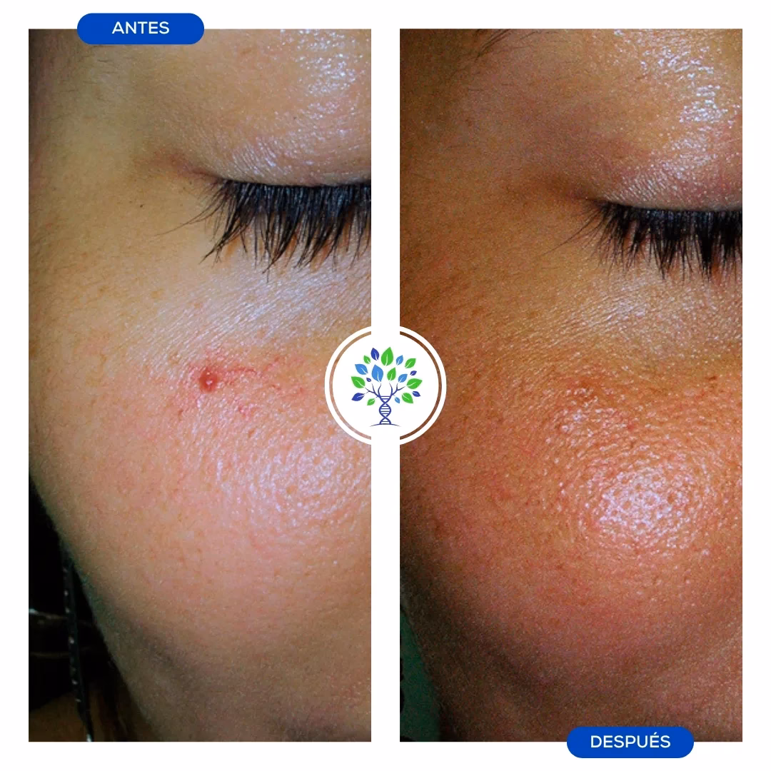 ¿Qué método es mejor para quitar arañas vasculares?