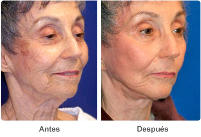 Guía Definitiva de Cirugías para Eliminar Arrugas