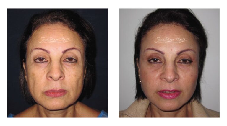 Eliminar Arrugas de la Frente: Guía Definitiva