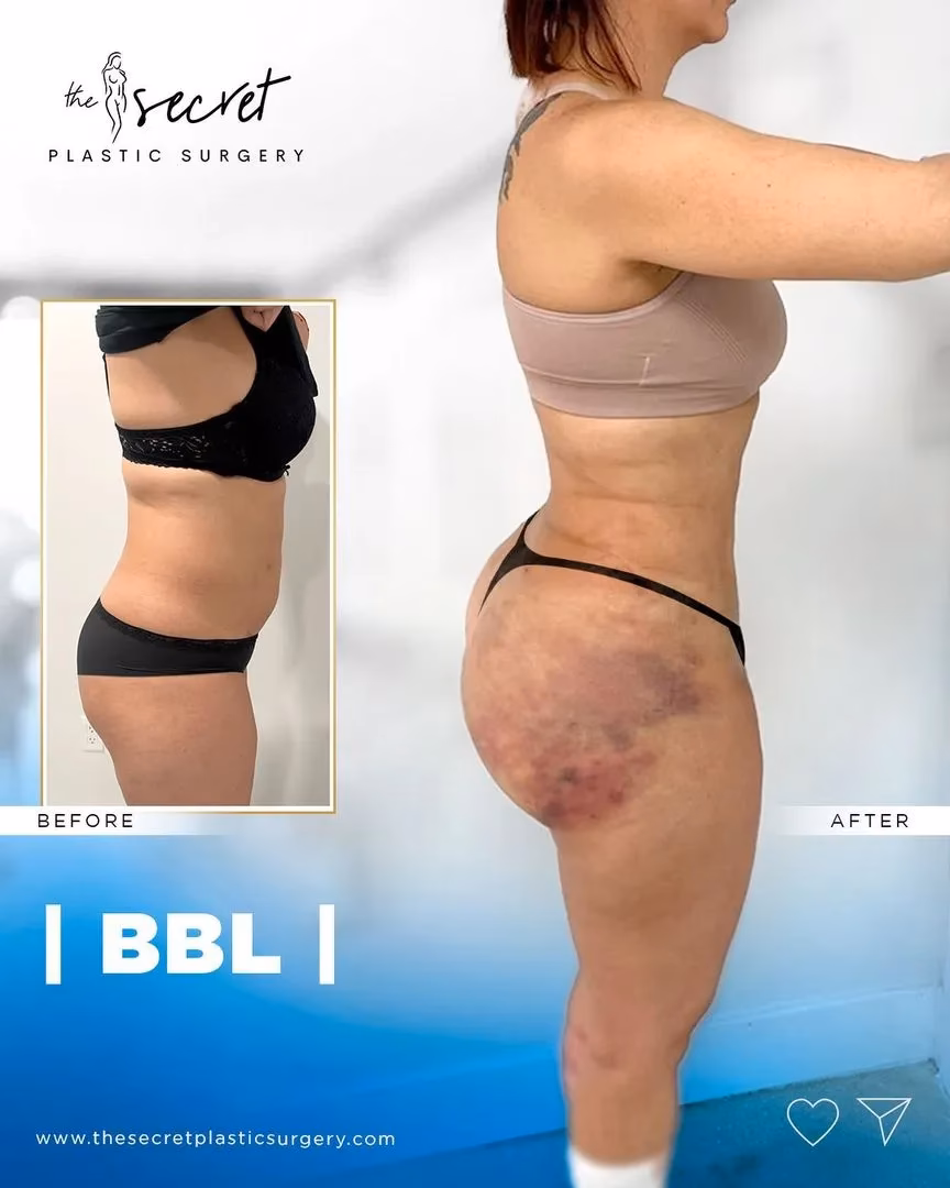 ¿Qué es más barato, lipo o bbl?