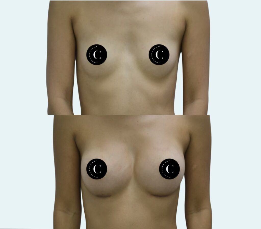 Costo de Cirugía de Senos en Puerto Rico: Guía 2024