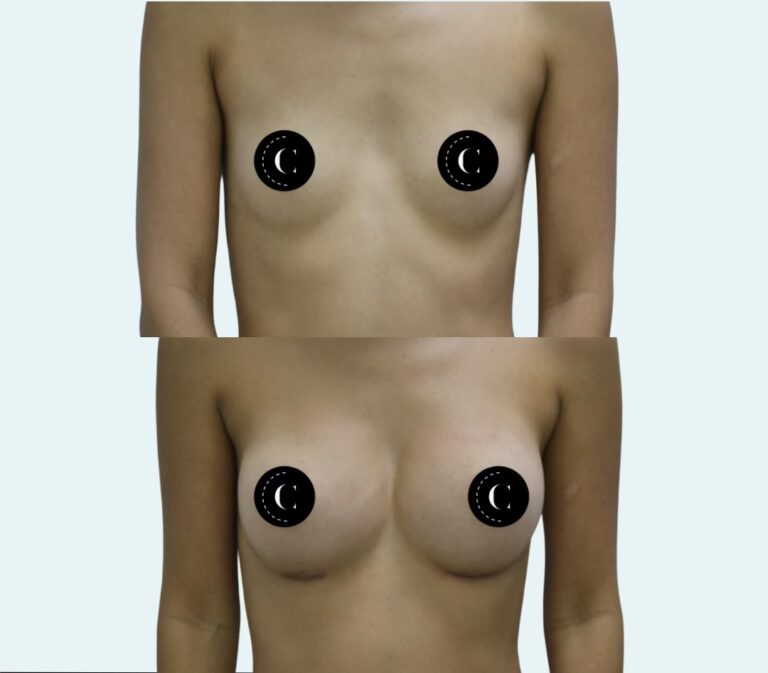 Costo de Cirugía de Senos en Puerto Rico: Guía 2024