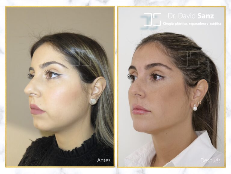 Precio de Abdominoplastia en Barcelona: Guía 2024