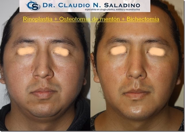 ¿Cuáles son las desventajas de la bichectomía?