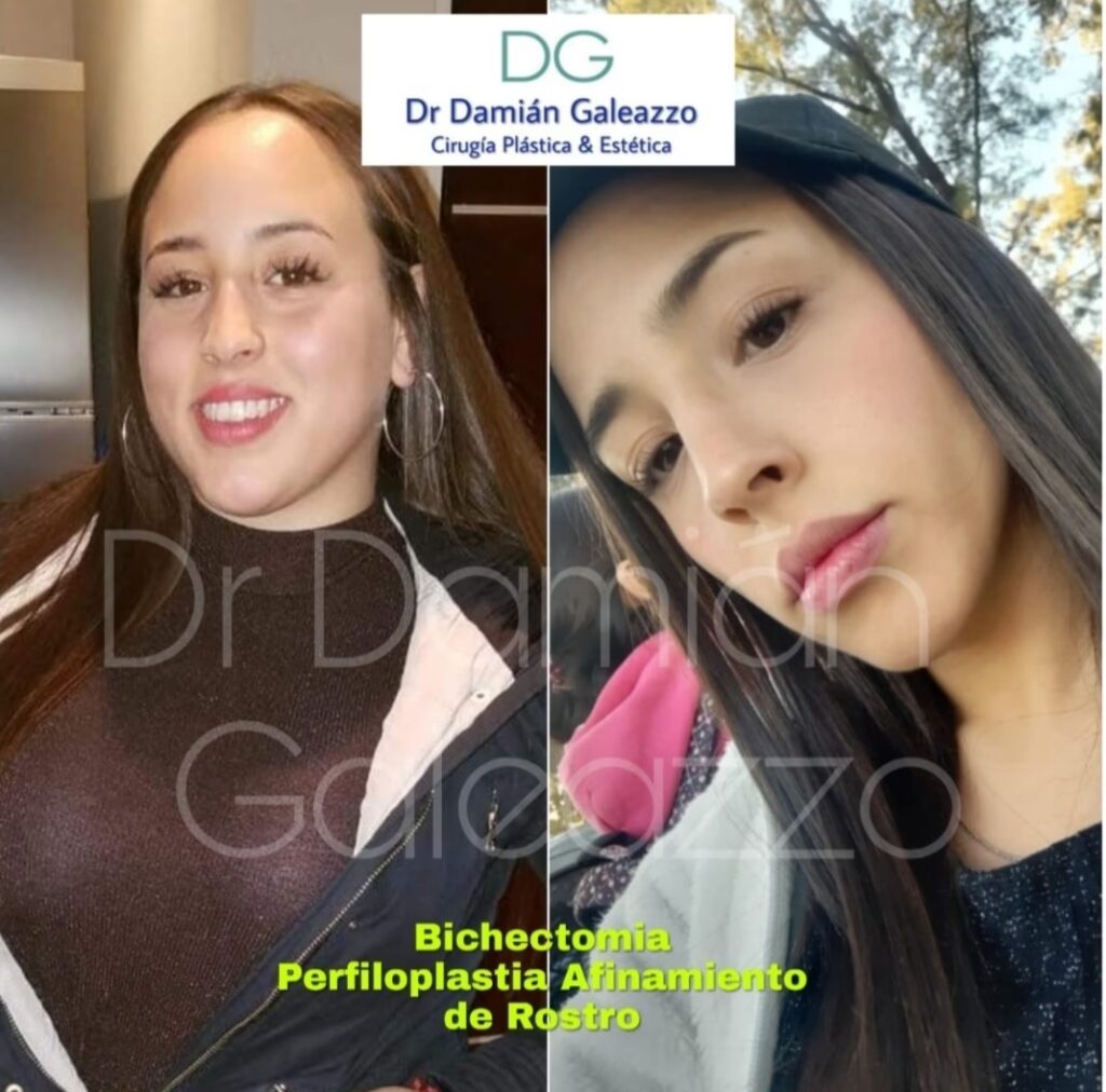 Bichectomía: Ventajas y Desventajas Clave