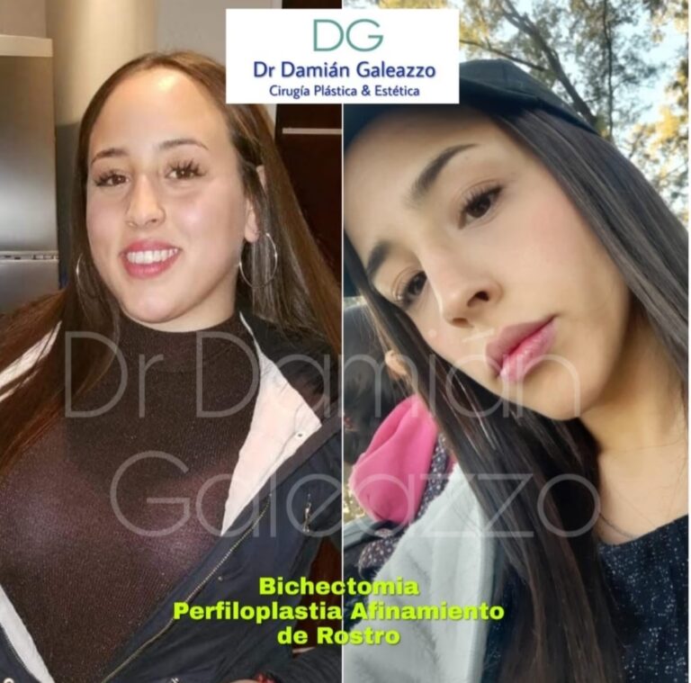 Bichectomía: Ventajas y Desventajas Clave