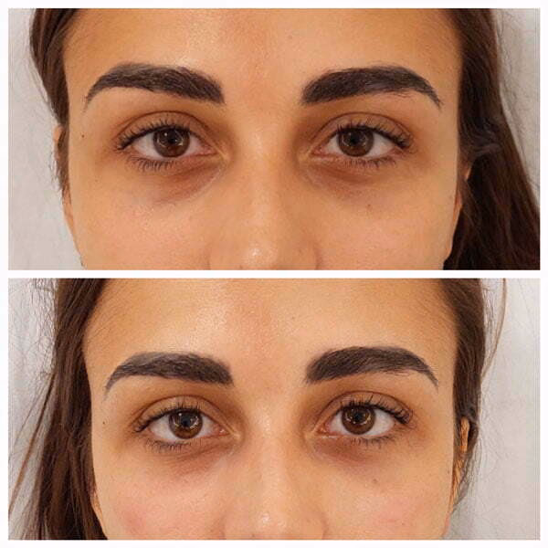 ¿Se pueden operar las ojeras oscuras?