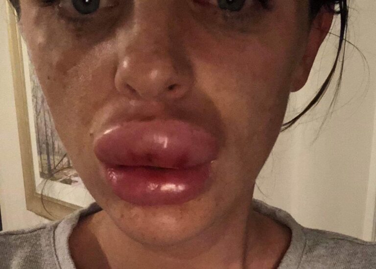 Signos de una Cirugía de Labios Mal Hecha