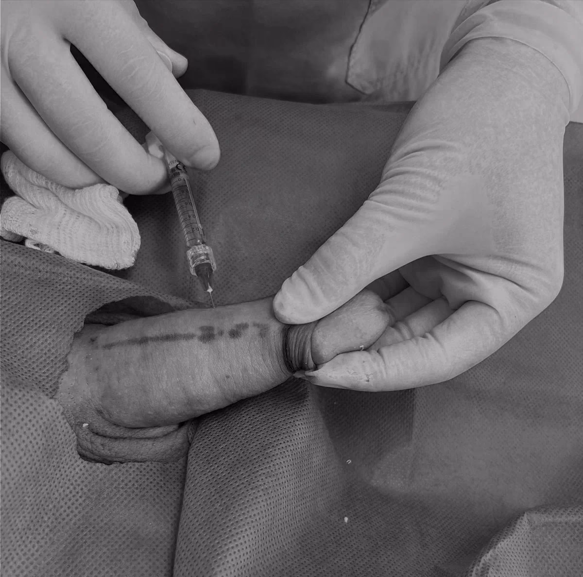 ¿Cuánto cuesta una operación de agrandamiento de miembro?