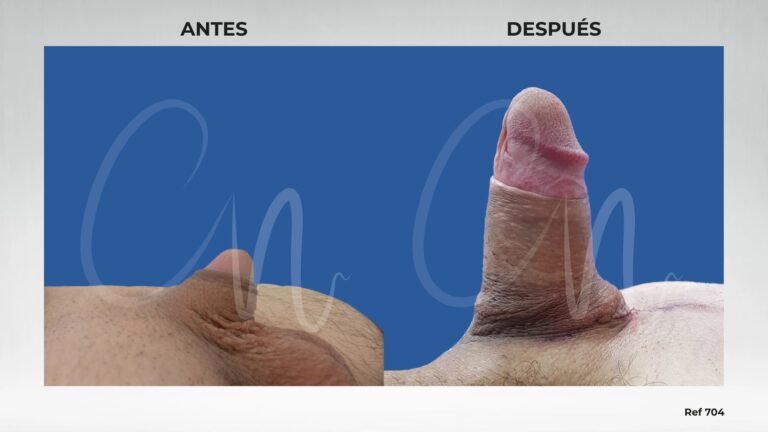 Alargamiento de Miembro: Costos, Riesgos y Realidad