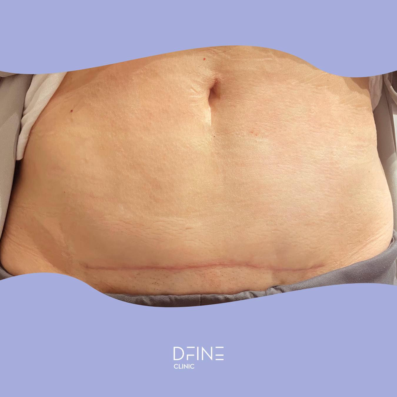 ¿Cuánto cuesta la eliminación de la cicatriz de la cesárea?