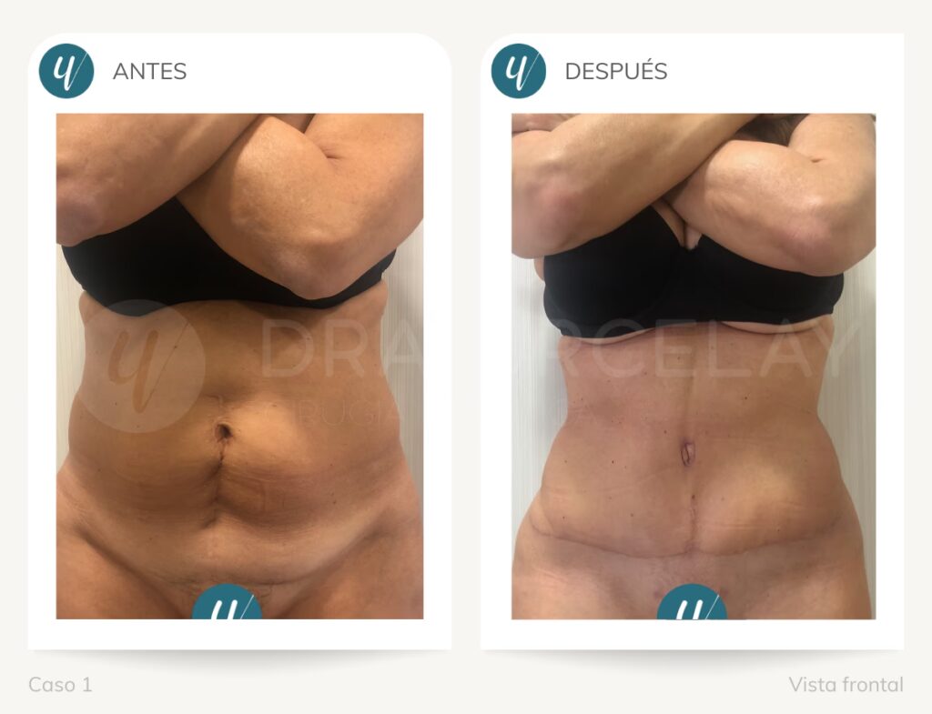 Zetaplastia: El Arte de Corregir Cicatrices