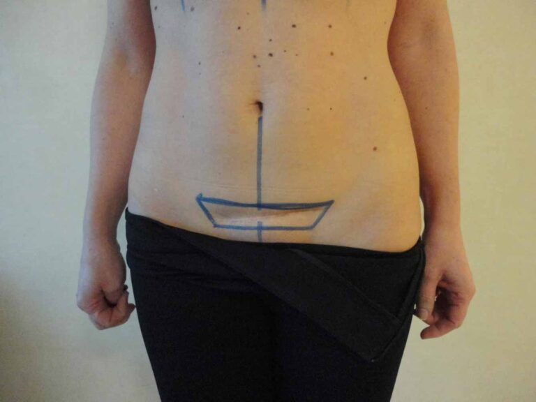 Cesárea Estética: Renueva tu Abdomen Postparto