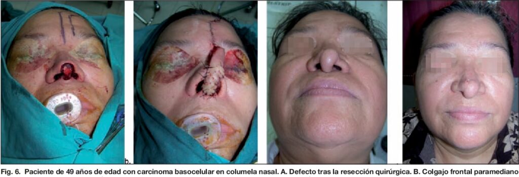 Efectos Secundarios del Colgajo Frontal en Nariz