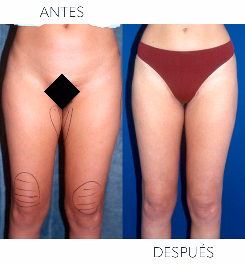 ¿Cuánto cuesta una liposucción de rodillas?