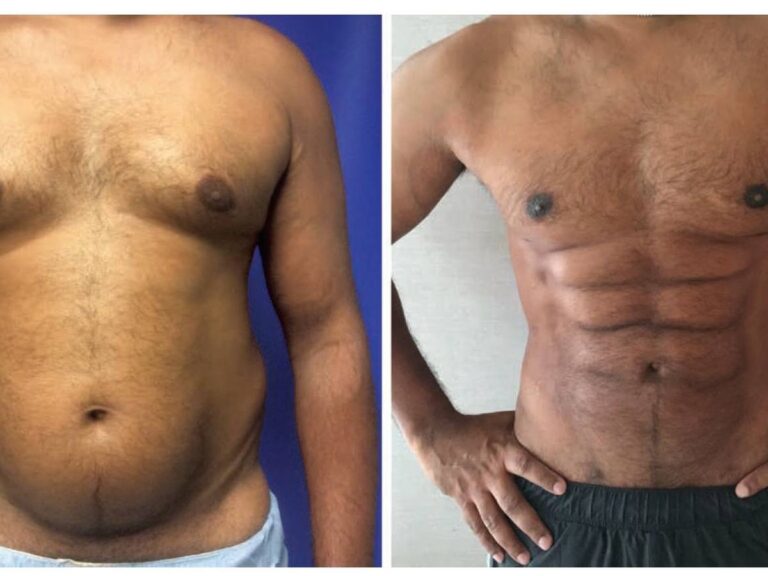 Peso Ideal para Cirugía: Abdominoplastia y Lipo HD