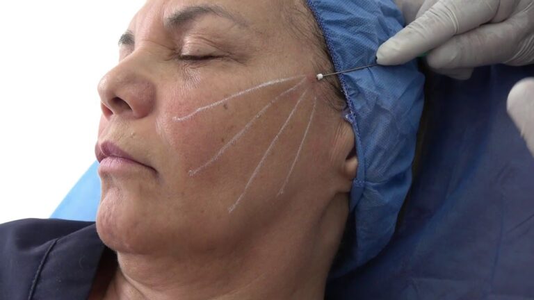 Hilos Tensores: Guía Completa de Precios y Beneficios