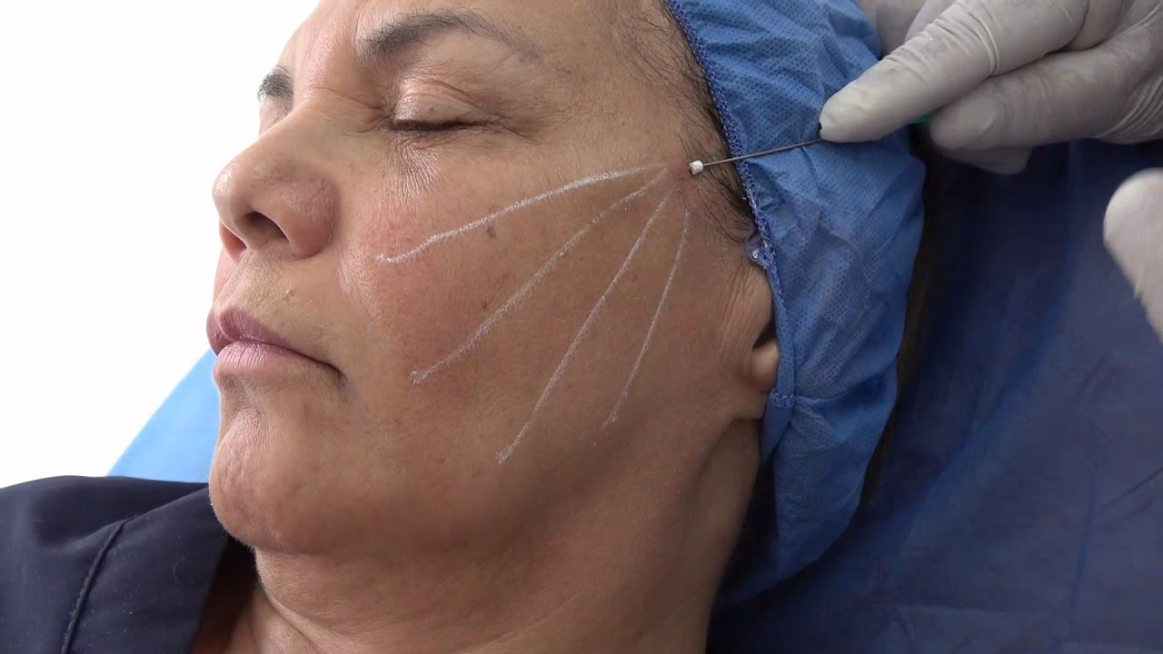 ¿Por qué a los cirujanos plásticos no les gustan los hilos tensores?