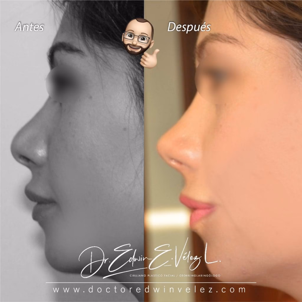 ¿Cuánto vale una rinoplastia en Pereira?