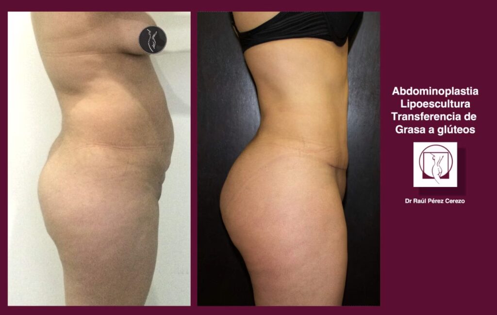 Costo de Abdominoplastia: Guía Completa de Precios