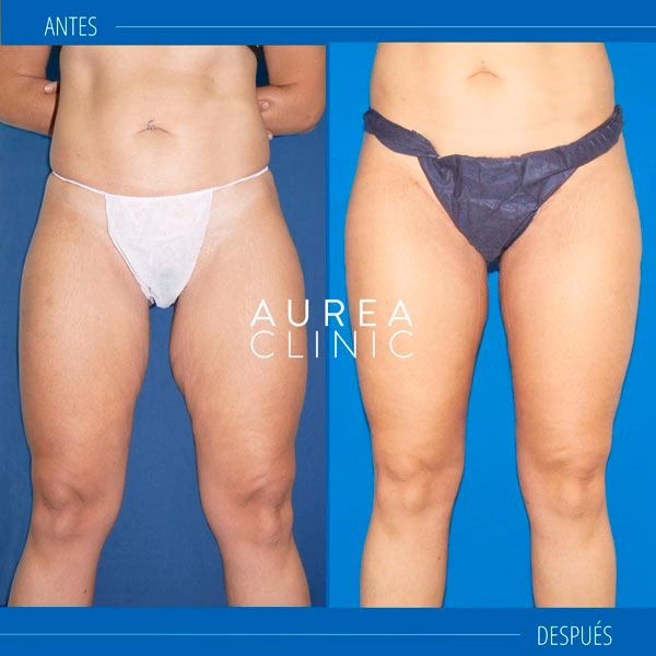 ¿Qué es la cirugía de liberación de aductores?