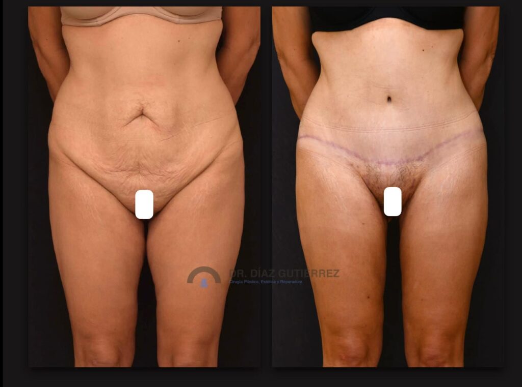 Guía Completa del Lifting de Muslos y Entrepiernas