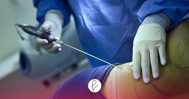 Lipoescultura 360°: La Guía Definitiva