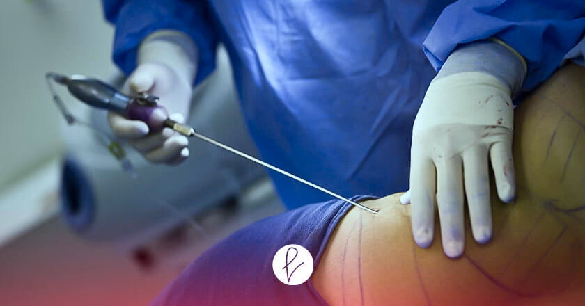 Lipoescultura 360°: La Guía Definitiva