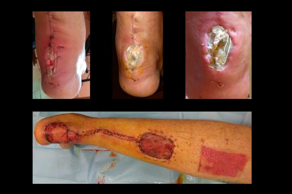 Recuperación de Cirugía de Tendón de Aquiles