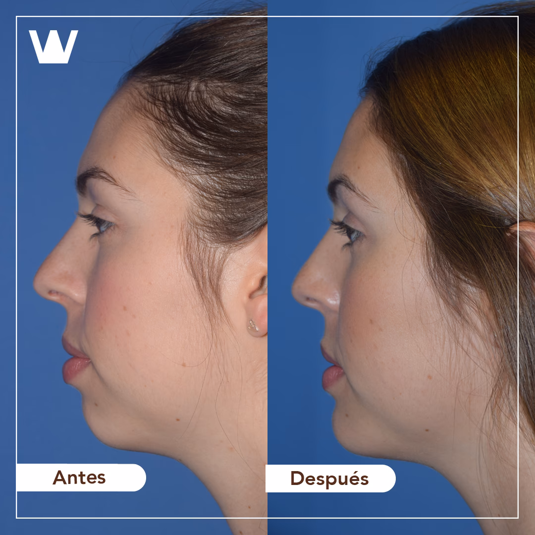 ¿Cómo se llama la cirugía para la barbilla?