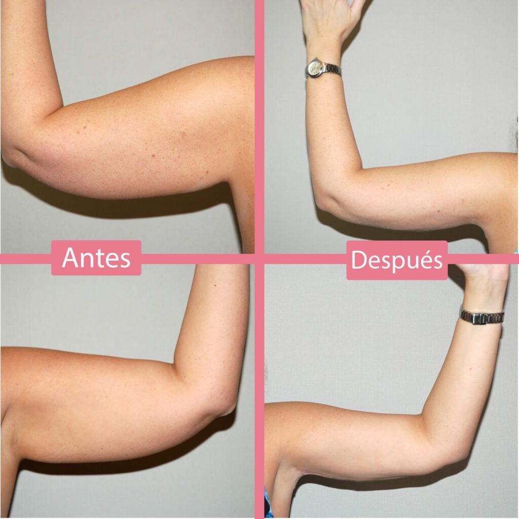 Costo de la Cirugía de Brazos: Guía Completa