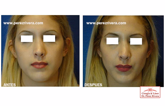 Bichectomía: El Secreto de un Rostro Definido