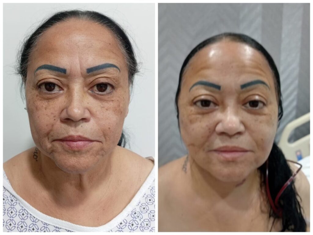 Cirugía Plástica en Cancún: Rejuvenece tu Rostro