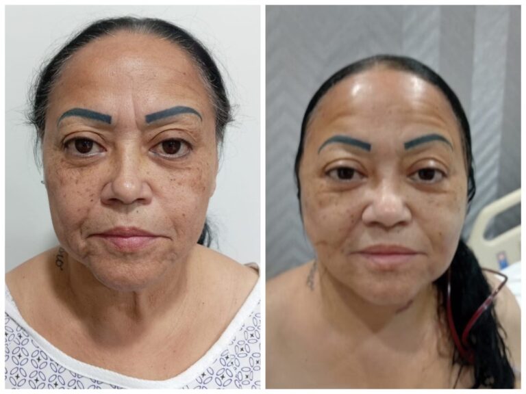 Cirugía Plástica en Cancún: Rejuvenece tu Rostro