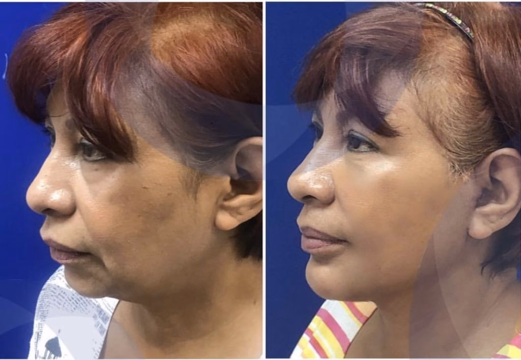 ¿Cuál es la mejor ciudad de México para la cirugía plástica?