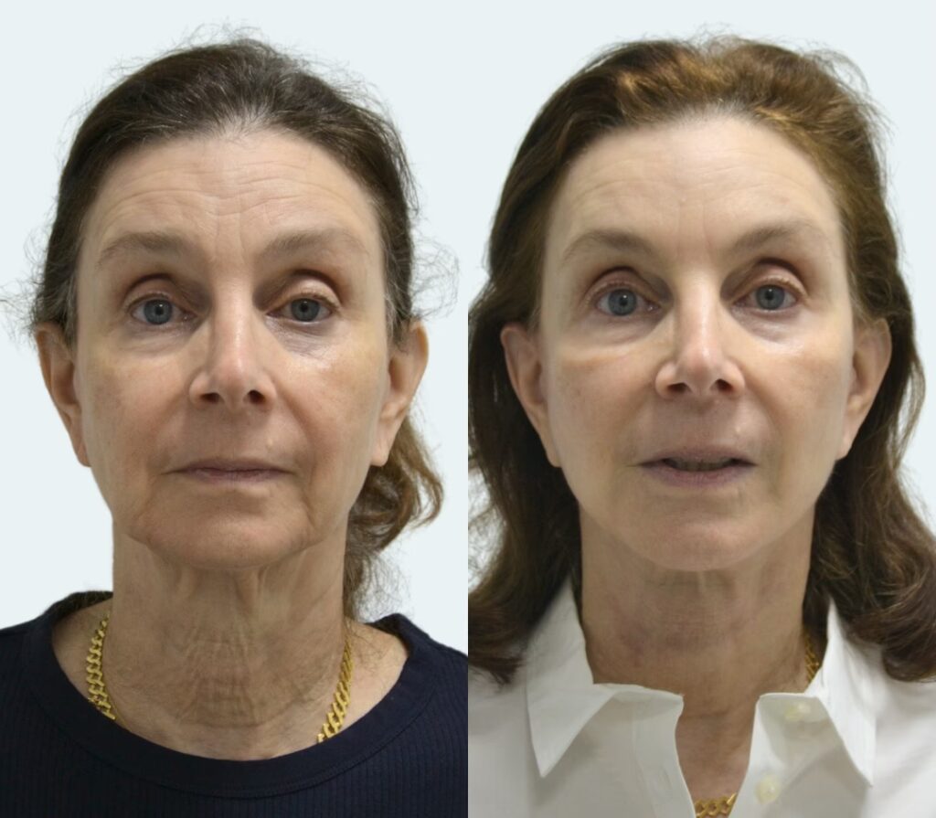 Costo de la Cirugía de Papada en Puerto Rico