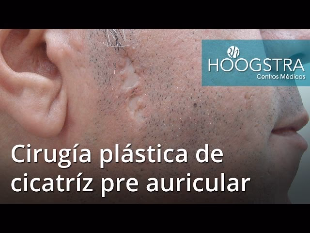 Zetaplastia: La Solución a Cicatrices Faciales
