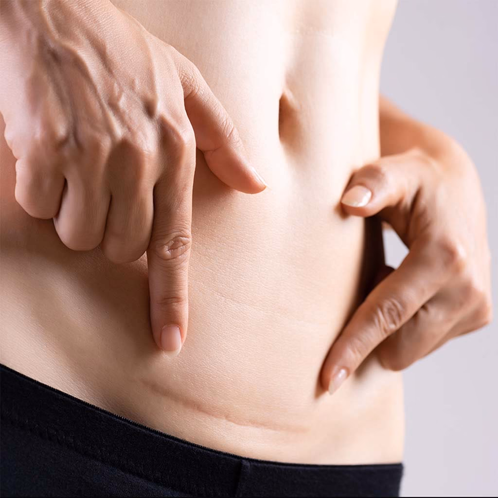 ¿Cómo puedo arreglar una cicatriz de cesárea?