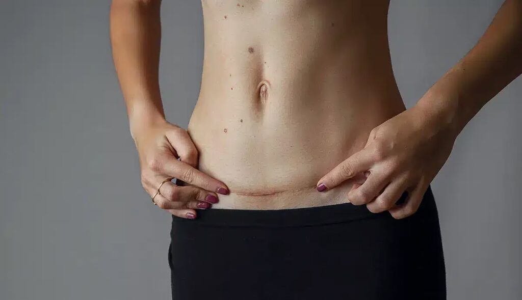 La Cicatriz de la Abdominoplastia: Guía Completa