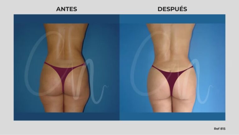 Costo de Liposucción de Cintura en EE.UU.