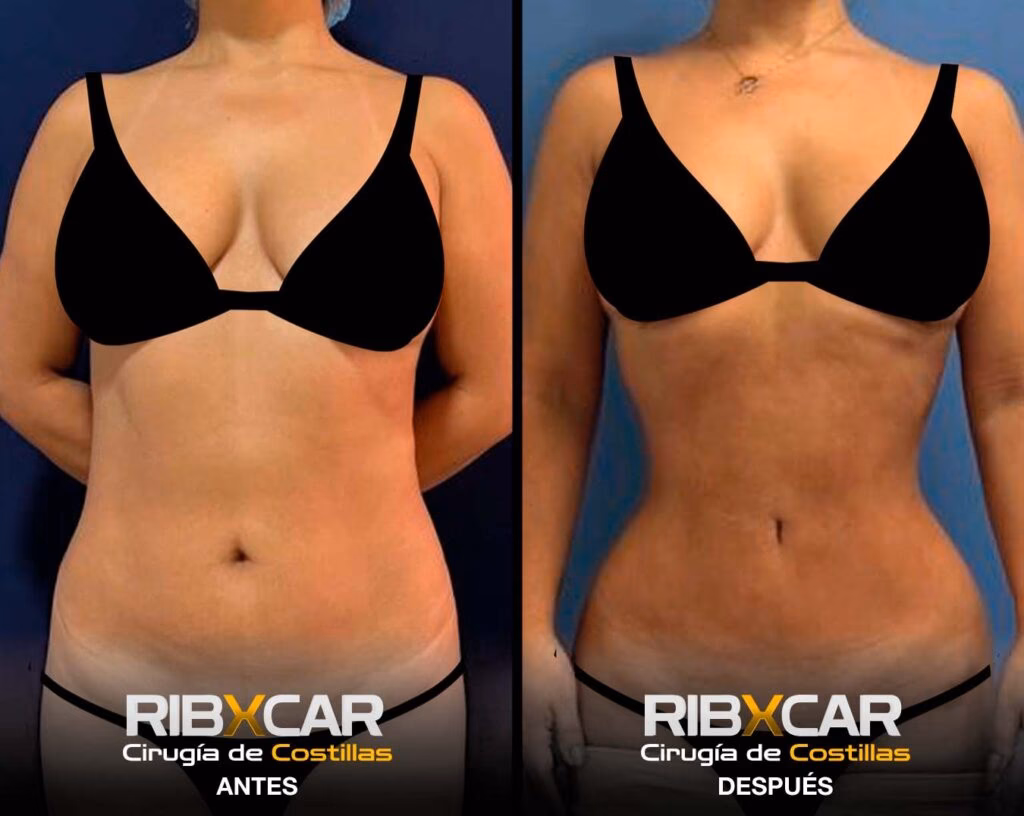 ¿Cuánto dura la recuperación de una operación de costillas?