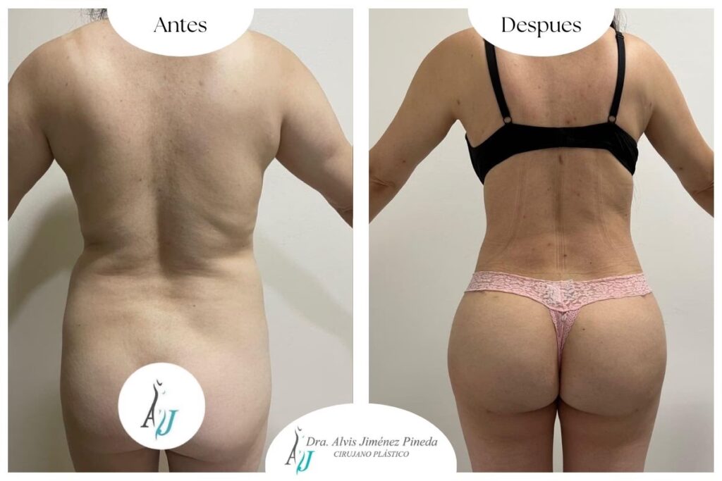 Recuperación de Operación de Costillas: Guía Completa