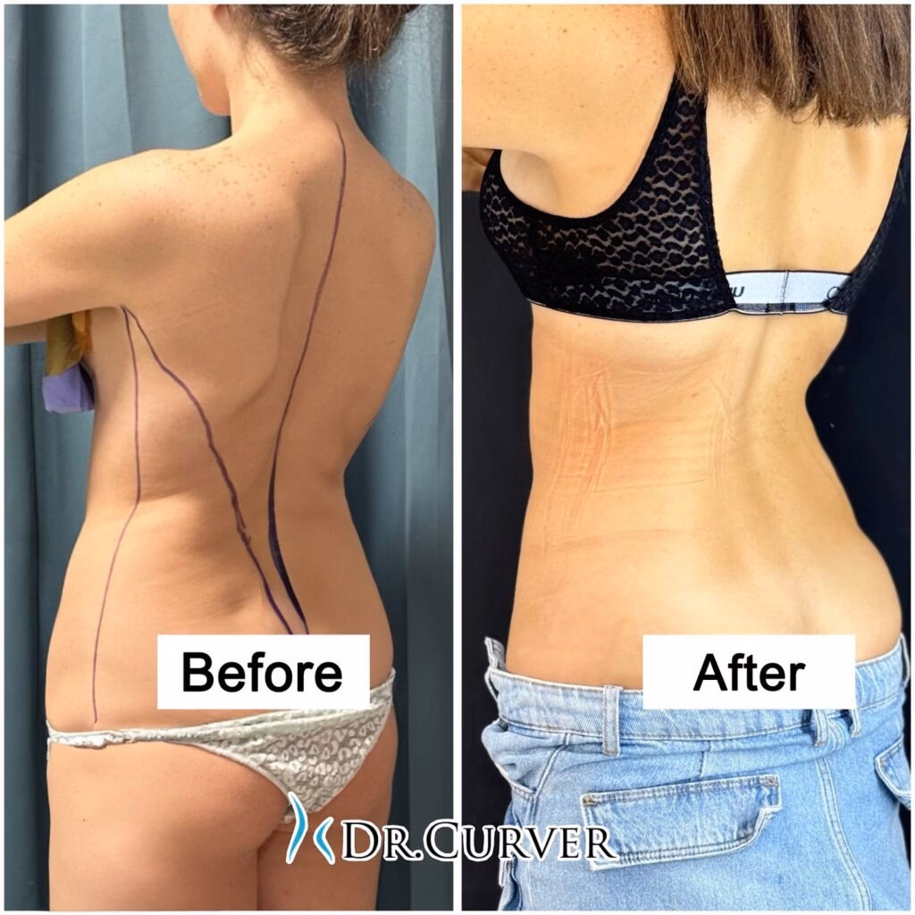 ¿Qué tan riesgosa es una operación de costillas?