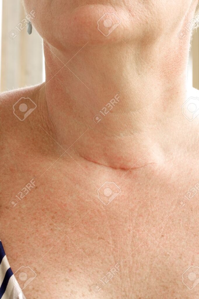 Cicatriz Tras Cirugía de Cuello: Guía Completa