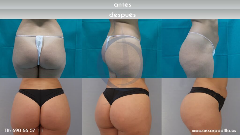 Recuperación de la Gluteoplastia: Guía Completa