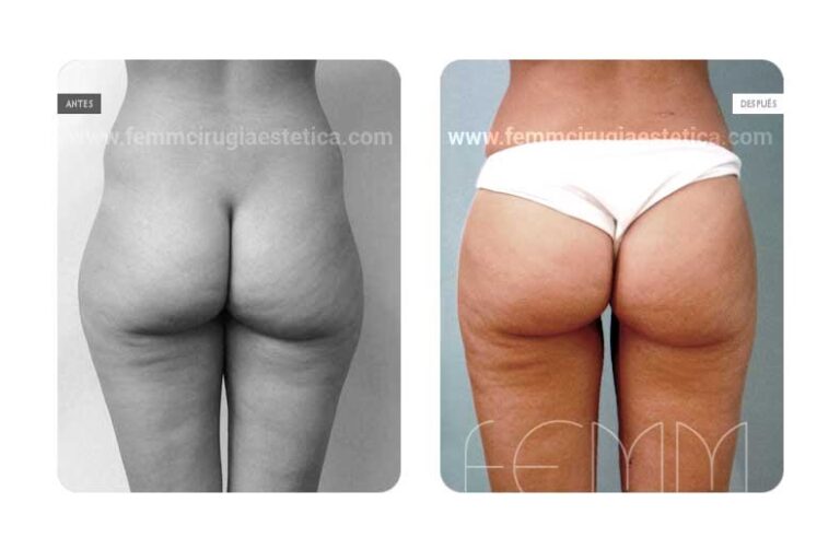 Aumento de Glúteos con Grasa Propia: Guía Completa