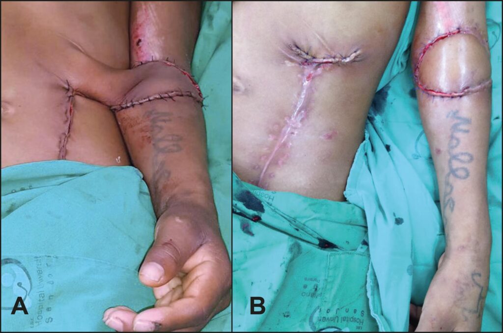 Cirugía de Colgajo: Guía de Recuperación y Tipos