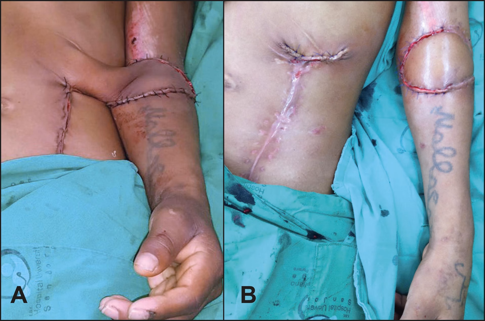 ¿Cómo se llama la operación de los colgajos?