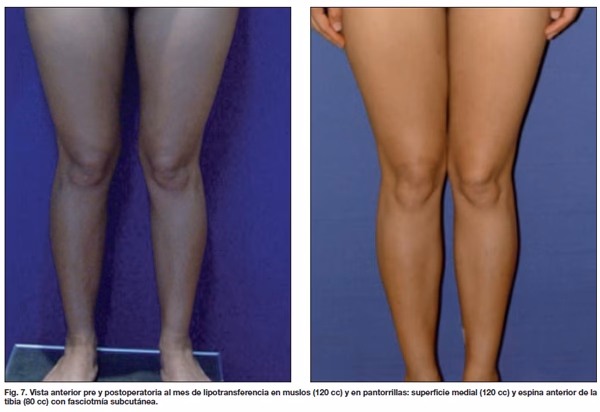 ¿Cuánto cuesta una operación para quitar grasa de las piernas?